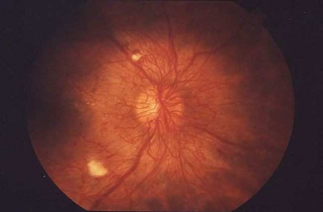 Zdjęcie dna oka z widocznymi zmianami. Retinopatia cukrzycowa to uszkodzenie naczyń siatkówki; drobne wybroczyny i wysięki bywają łatwe do przeoczenia